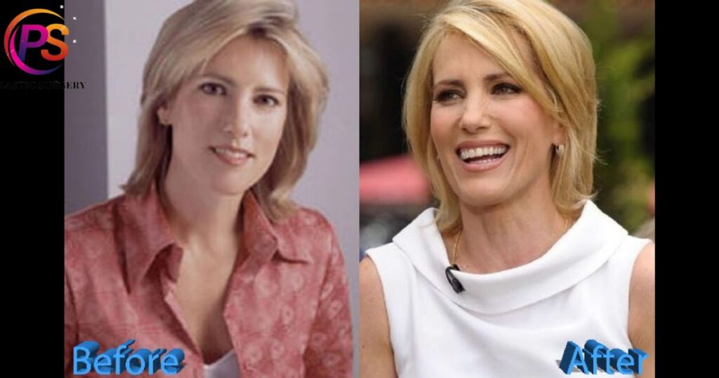 Laura Ingraham: Before And After Picture