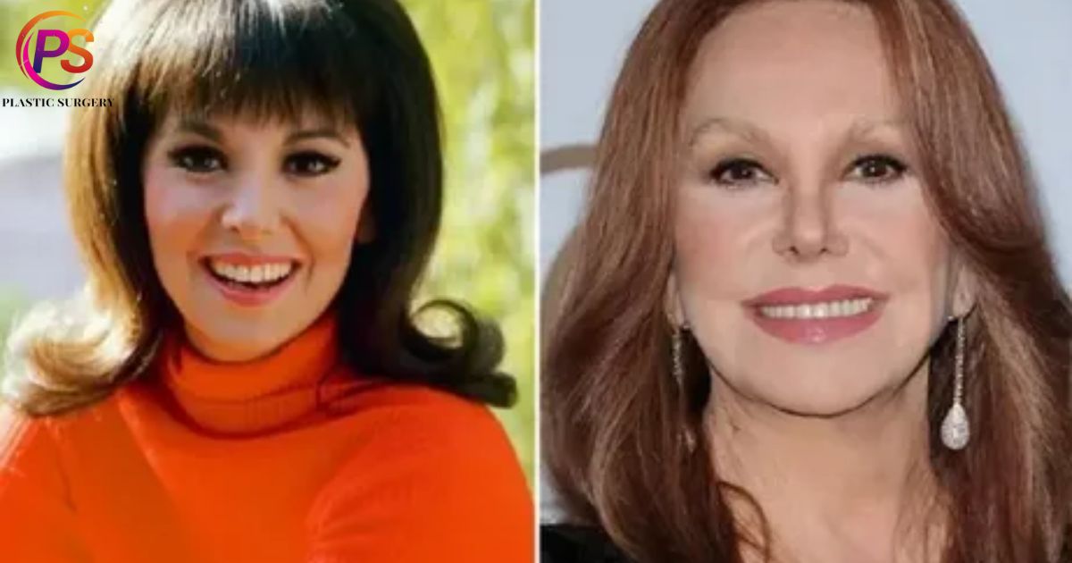 What happened to Marlo Thomas's face? Has Marlo had plastic surgery?
