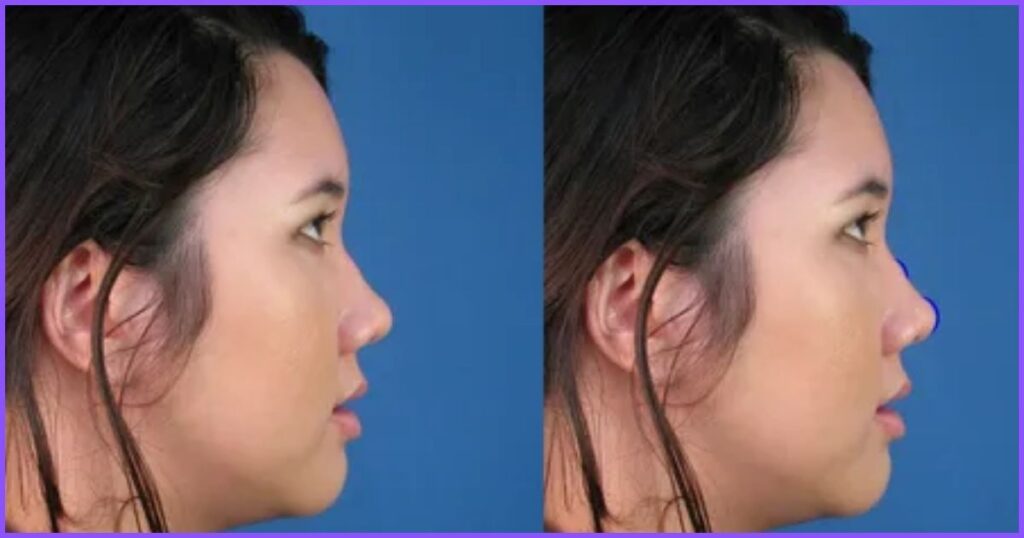 Asian nose job: Rhinoplasty and surgical implants