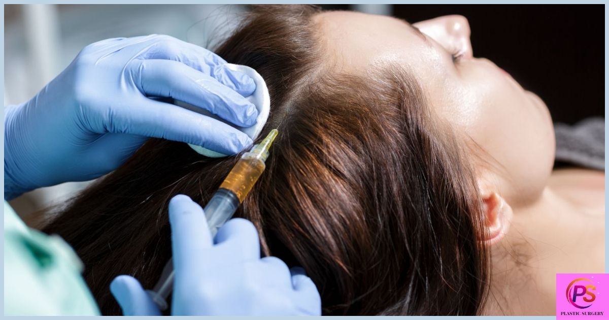 Benefits of PRP Hair Treatment