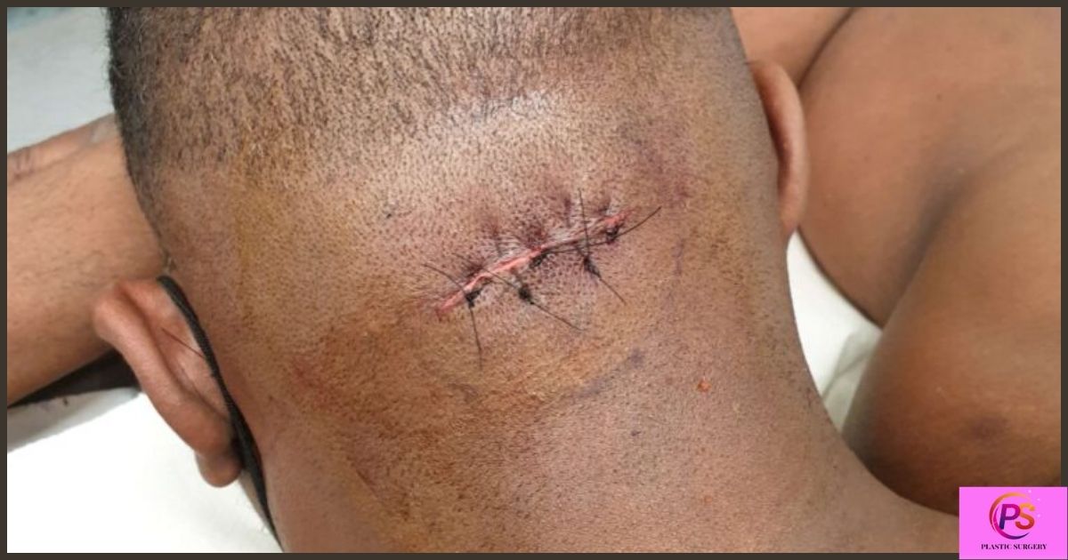 Can a lipoma grow back after surgery