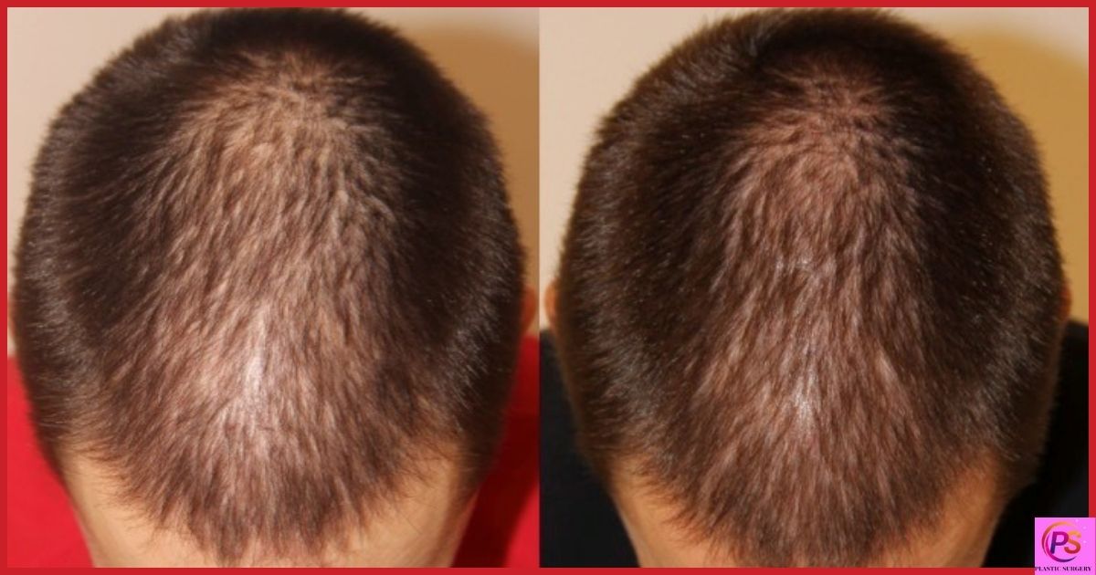 Combining PRP with Other Hair Loss Treatments