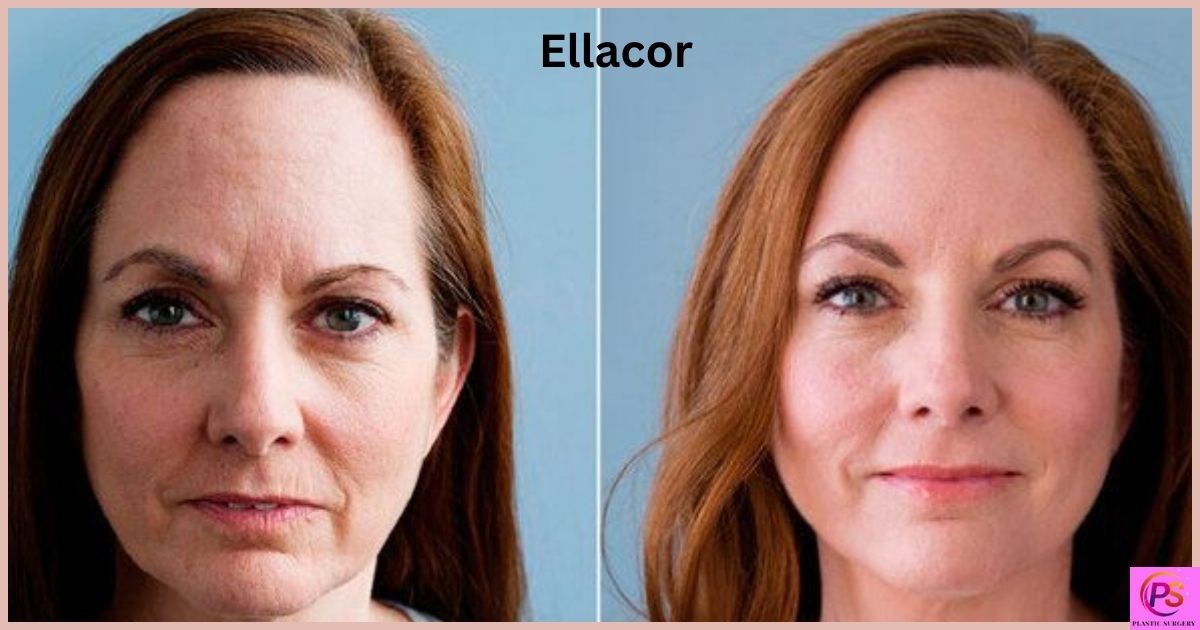 Ellacor Before And After