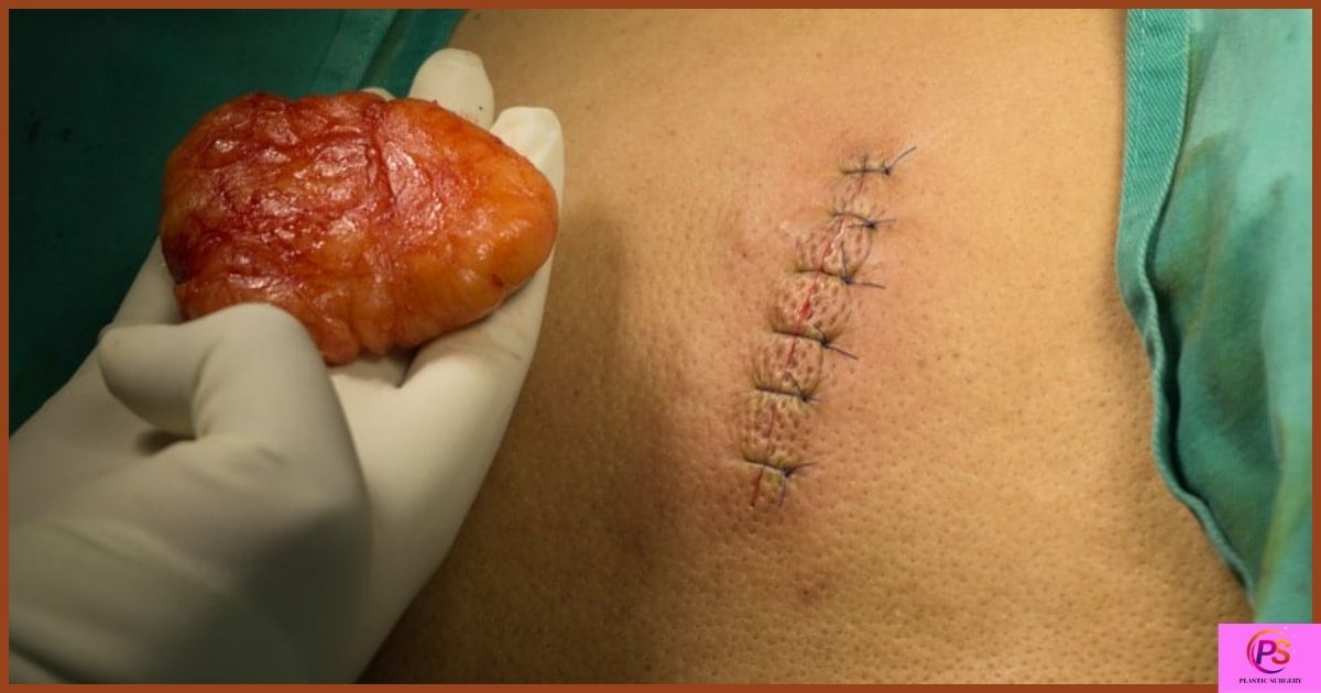 How long does it take to recover from lipoma surgery