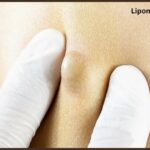 Lipoma Removal