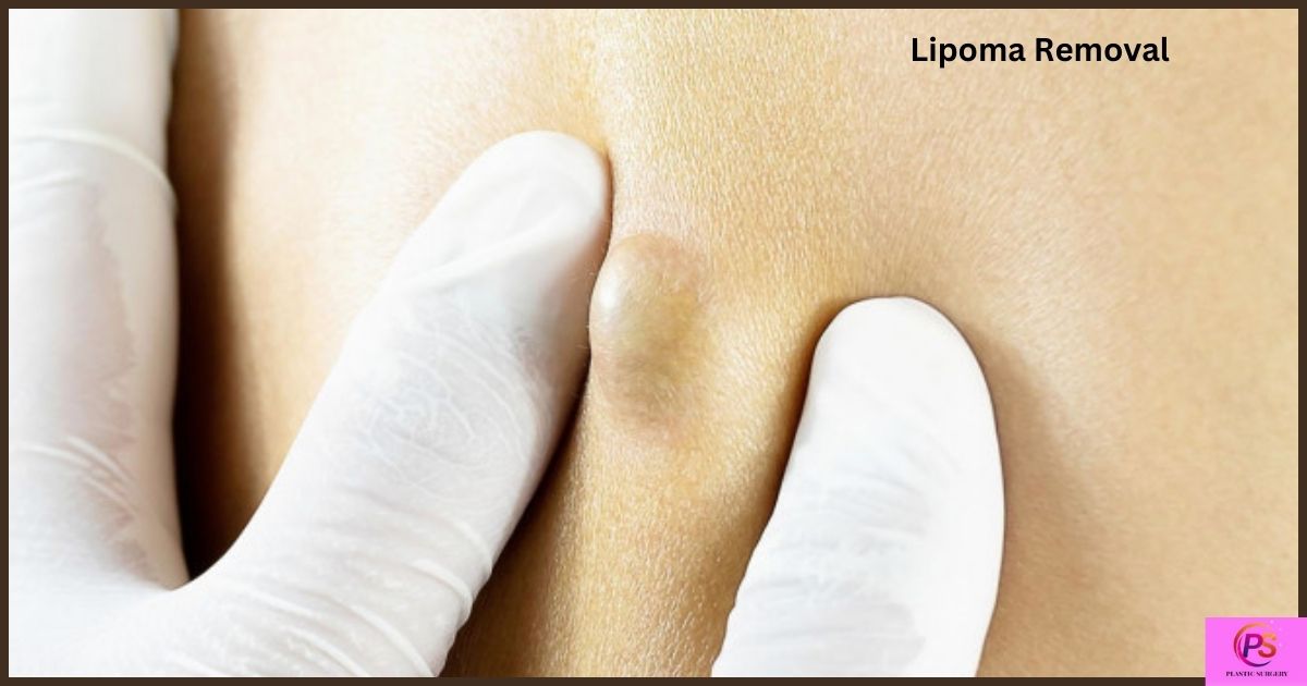 Lipoma Removal Cost: Breakdown Affordabl Options and Pricing