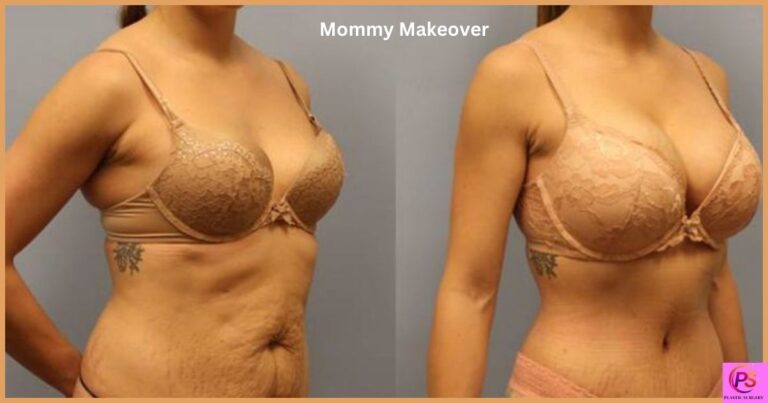 Mommy Makeover Before And After