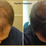 prp-hair-treatment