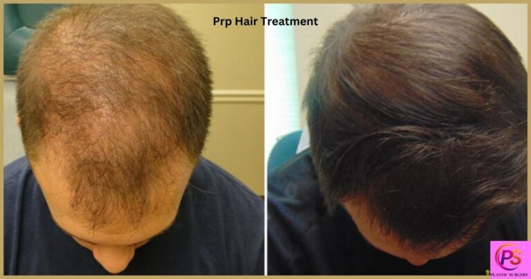 prp-hair-treatment