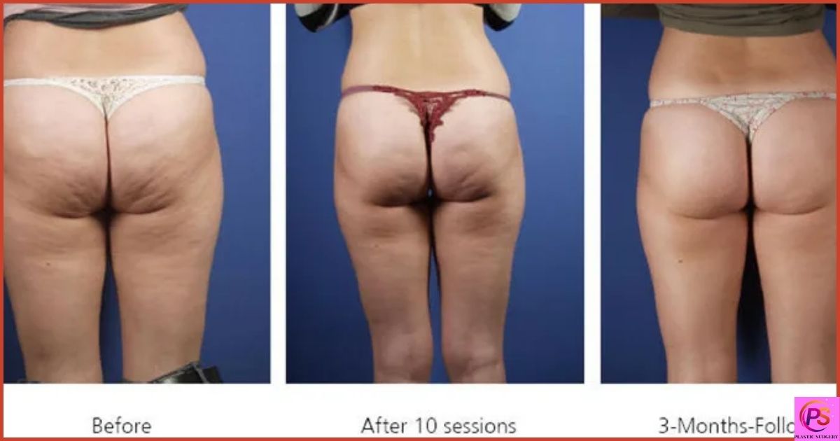 Types of Brazilian Butt Lift Shapes - Do They Affect The Cost