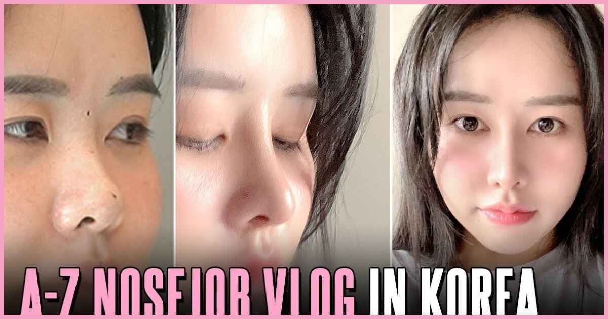 What are the Korean Rhinoplasty Trends