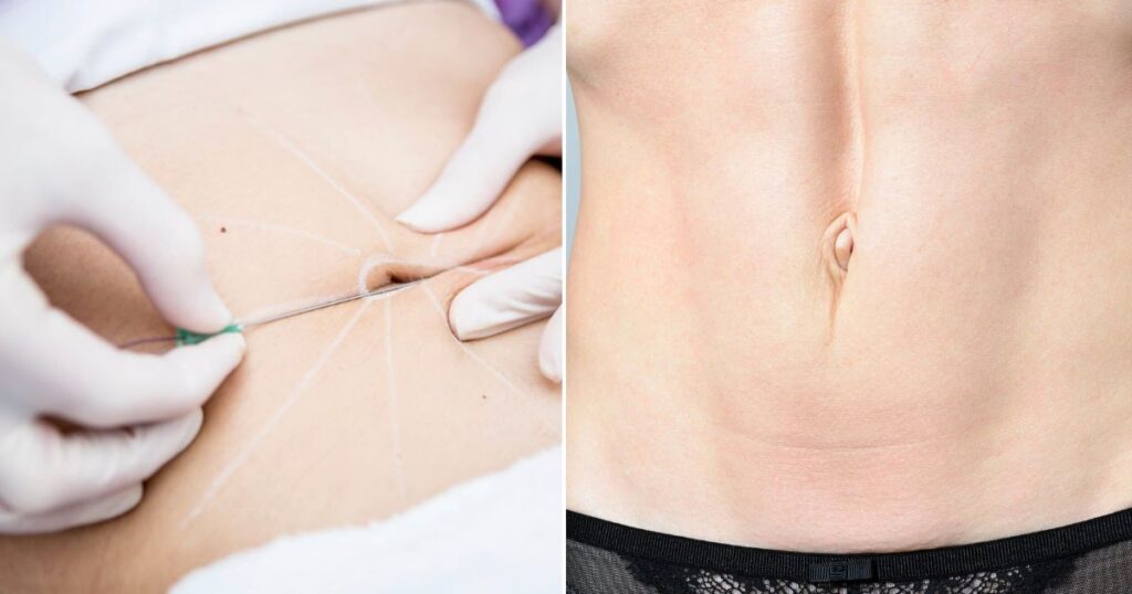 What is Belly Button Reconstruction Surgery