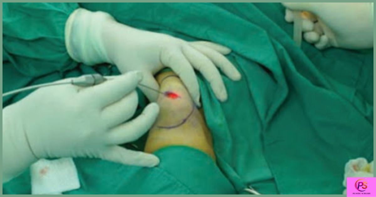 When is lipoma surgery recommended